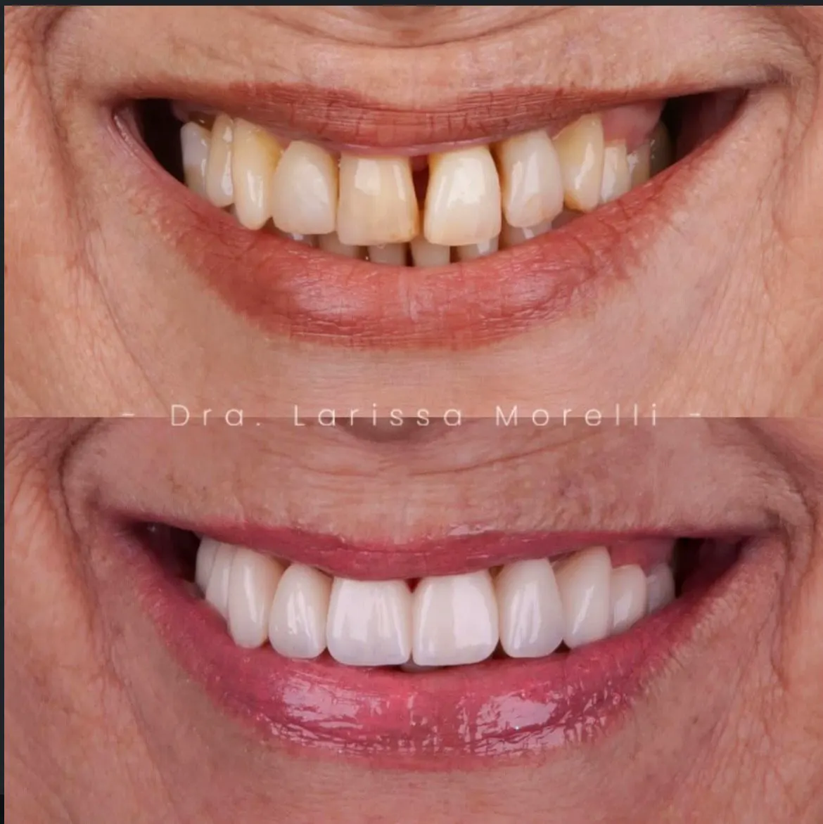 Antes e depois de lentes de contato dental — caso 1
