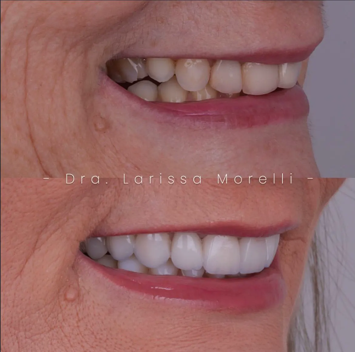 Antes e depois de lentes de contato dental — caso 2