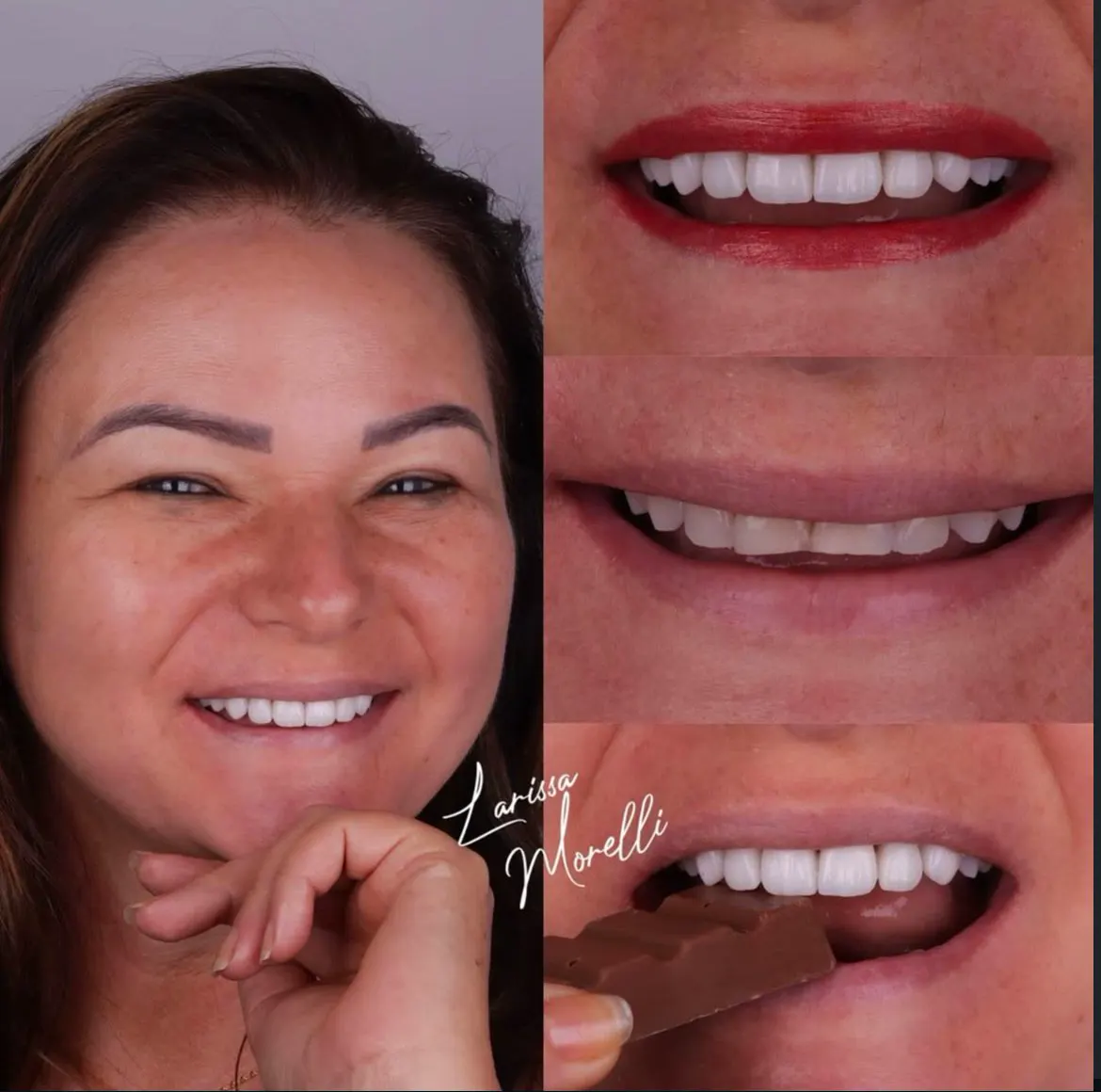 Antes e depois de lentes de contato dental — caso 3