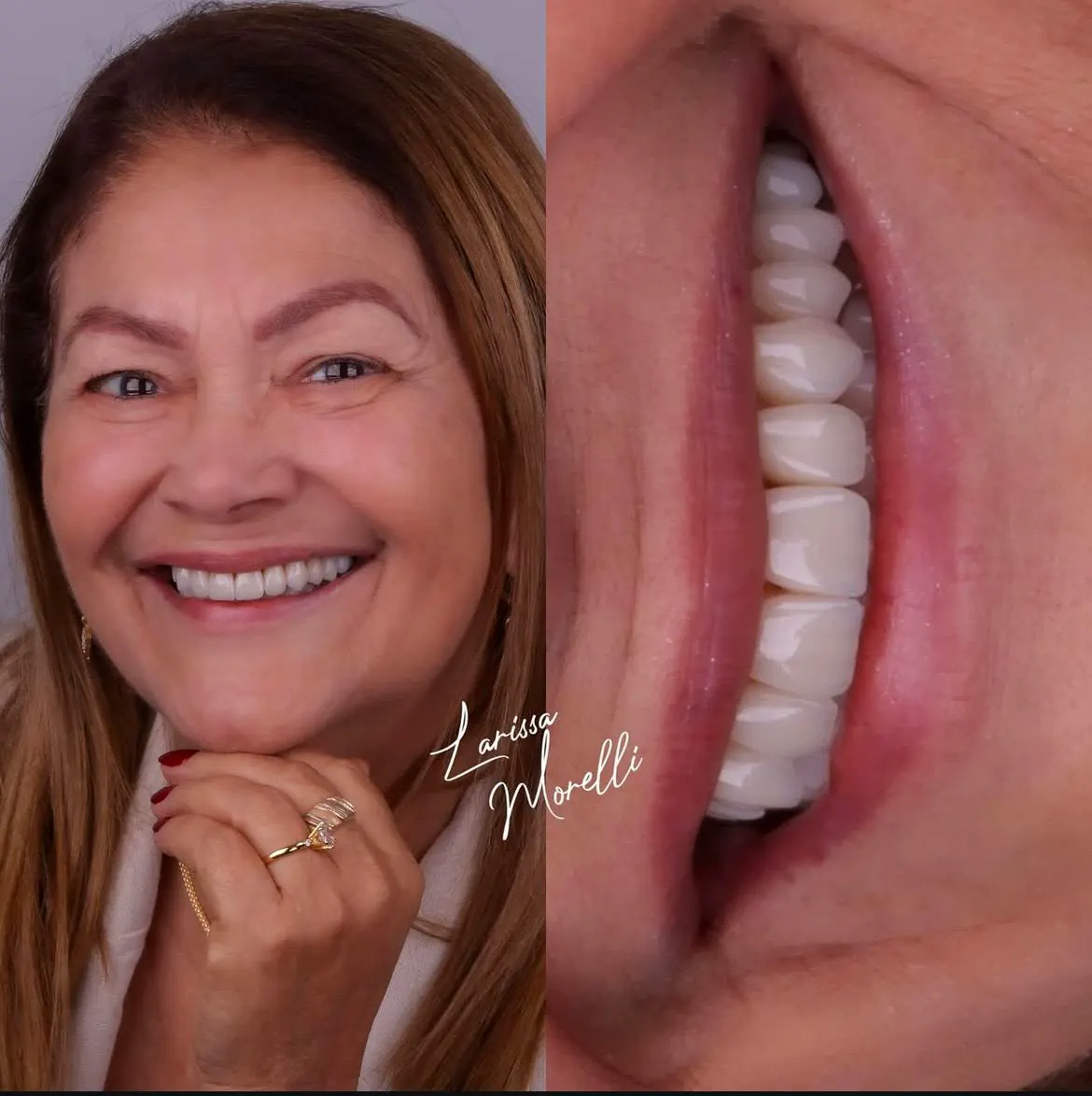 Sorriso com lentes de contato dental feitas na OrtoATM